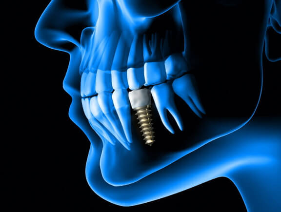 Implantologie, Zahnarzt Essen Zentrum, Dr. Koravi