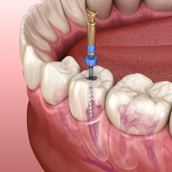 Endodontie, Zahnarzt Essen Zentrum, Dr. Koravi