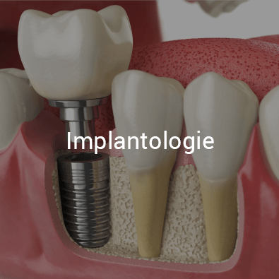 Implantologie, Zahnarzt Essen Zentrum, Dr. Koravi