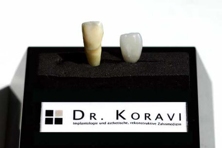 Veneers, Zahnarzt Essen Zentrum, Dr. Koravi