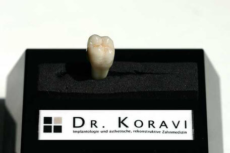 Zahnkronen, Zahnarzt Essen Zentrum, Dr. Koravi